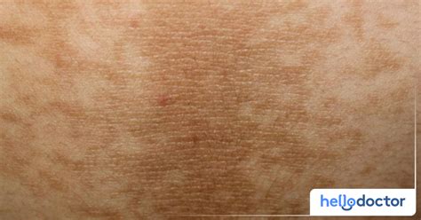 maitim na leeg|Rashes Ng May Diabetes: Heto Ang Lahat Ng Dapat Mong Tandaan.